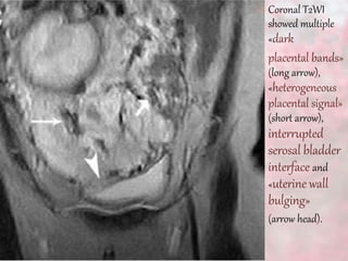 Coronal T2WI
showed multiple
«dark
placental bands»
(long arrow),
«heterogeneous
placental signal»
(short arrow),
interrupted
serosal bladder
interface and
«uterine wall
bulging»
(arrow head).
 