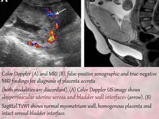 Color Doppler (A) and MRI (B), false-positive sonographic and true-negative
MRI findings for diagnosis of placenta accreta
(both modalities are discordant). (A) Color Doppler US image shows
«hypervascular uterine serosa and bladder wall interface» (arrow). (B)
Sagittal T2WI shows normal myometrium wall, homogenous placenta and
intact serosal bladder interface.
 