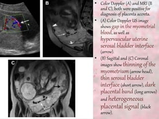 • Color Doppler (A) and MRI (B
and C), both were positive for
diagnosis of placenta accreta.
• (A) Color Doppler US image
shows gap in the myometrial
blood, as well as
hypervascular uterine
serosal bladder interface
(arrow).
• (B) Sagittal and (C) Coronal
images show thinning of the
myometrium(arrow head),
thin serosal bladder
interface (short arrow), dark
placental band (long arrows)
and heterogeneous
placental signal (black
arrow).
 