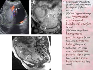• Color Doppler (A) and MRI
(B and C), both were positive
for diagnosis of placenta
accreta.
• (A) Color Doppler US image
shows hypervascular
uterine serosal
bladder wall interface
(arrow).
• (B) Coronal image shows
heterogeneous
placental signal (arrow
head), and uterine wall
bulging (long arrow).
• (C) Sagittal T2WI image
shows heterogeneous
placental signal (arrow
head) and thin serosal
bladder interface (long
arrow).
 