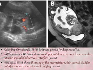 • Color Doppler (A) and MRI (B), both were positive for diagnosis of PA.
• (A) Transvaginal US image shows small placental lacunae and hypervascular
uterine serosal bladder wall interface (arrow).
• (B) Sagittal T2WI. shows thinning of the myometrium, thin serosal bladder
interface as well as uterine wall bulging (arrow).
 