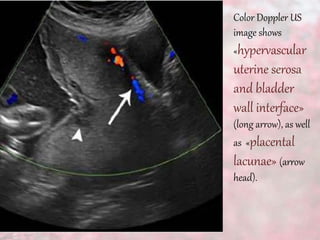 Color Doppler US
image shows
«hypervascular
uterine serosa
and bladder
wall interface»
(long arrow), as well
as «placental
lacunae» (arrow
head).
 
