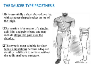 THE SAUCER-TYPE PROSTHESIS
It is essentially a short above-knee leg
with a saucer-shaped socket on top of
the thigh.
Suspension is by means of a single-
axis joint and pelvic band and may
include straps that pass over the
shoulder.
This type is most suitable for short
femur amputations because adequate
stability is difficult to achieve without
the additional bone structure.
 