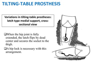 When the hip joint is fully
extended, the latch flips by dead
center and secures the socket to the
thigh.
A hip lock is necessary with this
arrangement.
Variations in tilting-table prostheses:
latch type medial support, cross-
sectional view
TILTING-TABLE PROSTHESIS
 