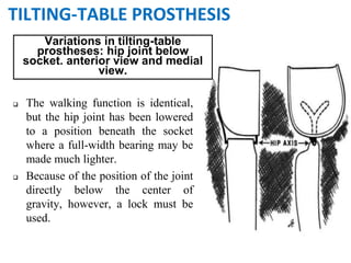 Variations in tilting-table
prostheses: hip joint below
socket. anterior view and medial
view.
 The walking function is identical,
but the hip joint has been lowered
to a position beneath the socket
where a full-width bearing may be
made much lighter.
 Because of the position of the joint
directly below the center of
gravity, however, a lock must be
used.
TILTING-TABLE PROSTHESIS
 