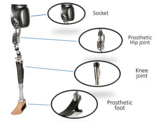 Socket
Prosthetic
Hip joint
Prosthetic
foot
Knee
joint
 