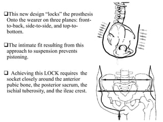 This new design “locks” the prosthesis
Onto the wearer on three planes: front-
to-back, side-to-side, and top-to-
bottom.
The intimate fit resulting from this
approach to suspension prevents
pistoning.
 Achieving this LOCK requires the
socket closely around the anterior
pubic bone, the posterior sacrum, the
ischial tuberosity, and the ileac crest.
 
