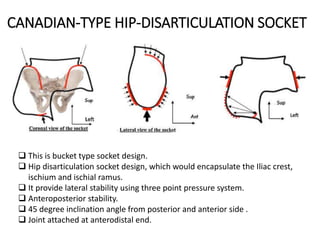 CANADIAN-TYPE HIP-DISARTICULATION SOCKET
 This is bucket type socket design.
 Hip disarticulation socket design, which would encapsulate the Iliac crest,
ischium and ischial ramus.
 It provide lateral stability using three point pressure system.
 Anteroposterior stability.
 45 degree inclination angle from posterior and anterior side .
 Joint attached at anterodistal end.
 