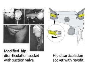 Hip disarticulation
socket with revofit
Modified hip
disarticulation socket
with suction valve
 