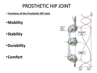 PROSTHETIC HIP JOINT
• Functions of the Prosthetic HIP Joint
•Mobility
•Stability
•Durability
•Comfort
 