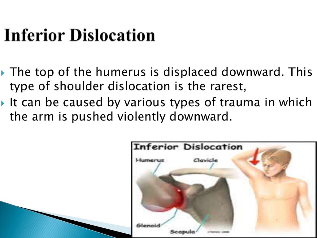 shoulder dislocation orthopedics + glenohumeral dislocation and man…