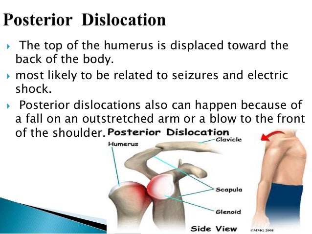 shoulder dislocation orthopedics + glenohumeral ...