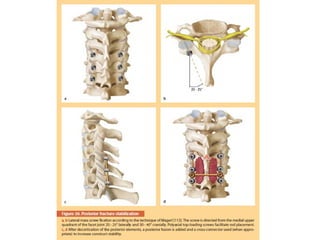 Osteoporoze
Galvēna problēma – skriemeļa ķermeņa deformācija, ar sekojošo
  kompresijas lūzumu.
 