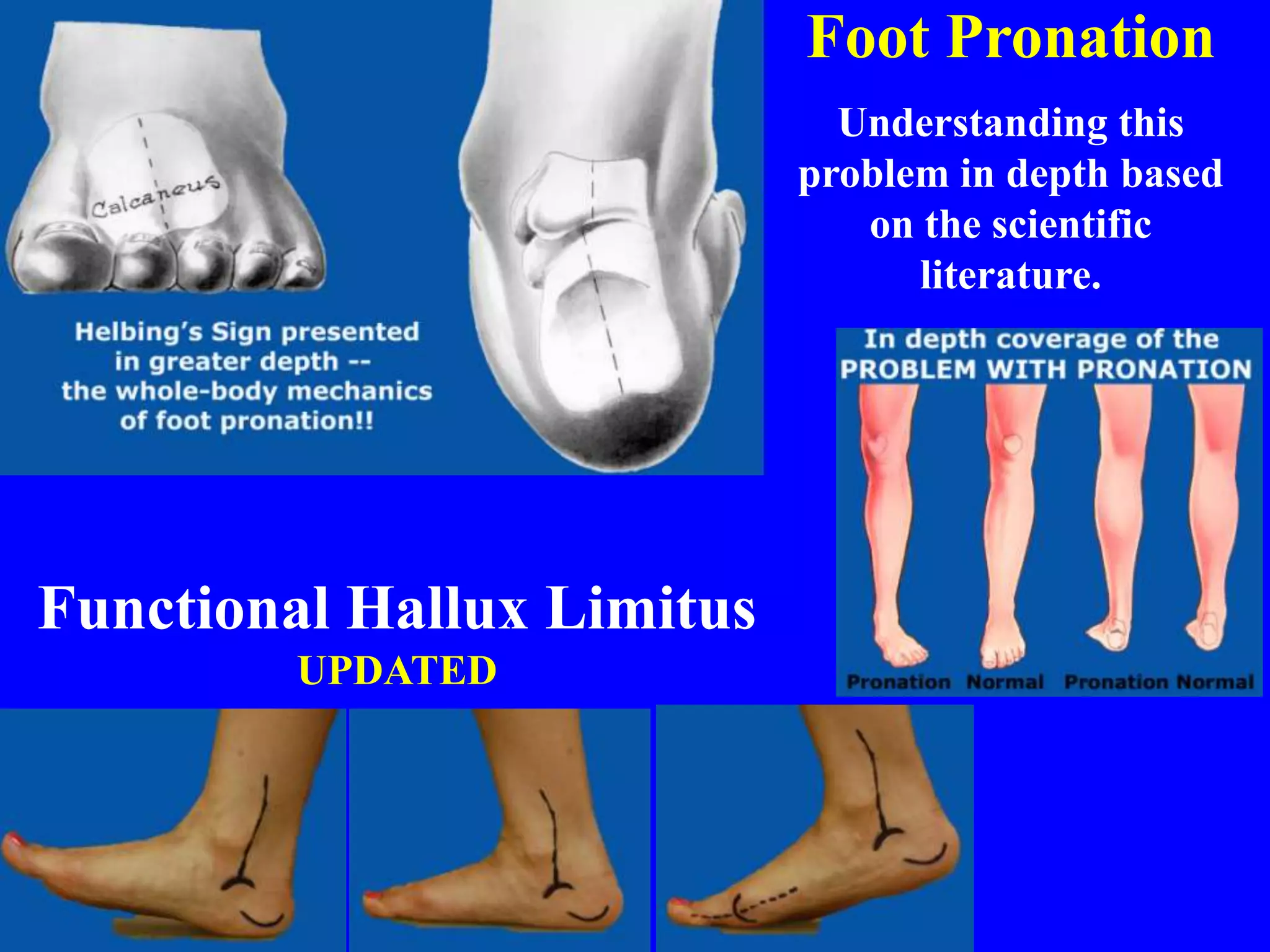 Functional Hallux Limitus
UPDATED
Foot Pronation
Understanding this
problem in depth based
on the scientific
literature.
 