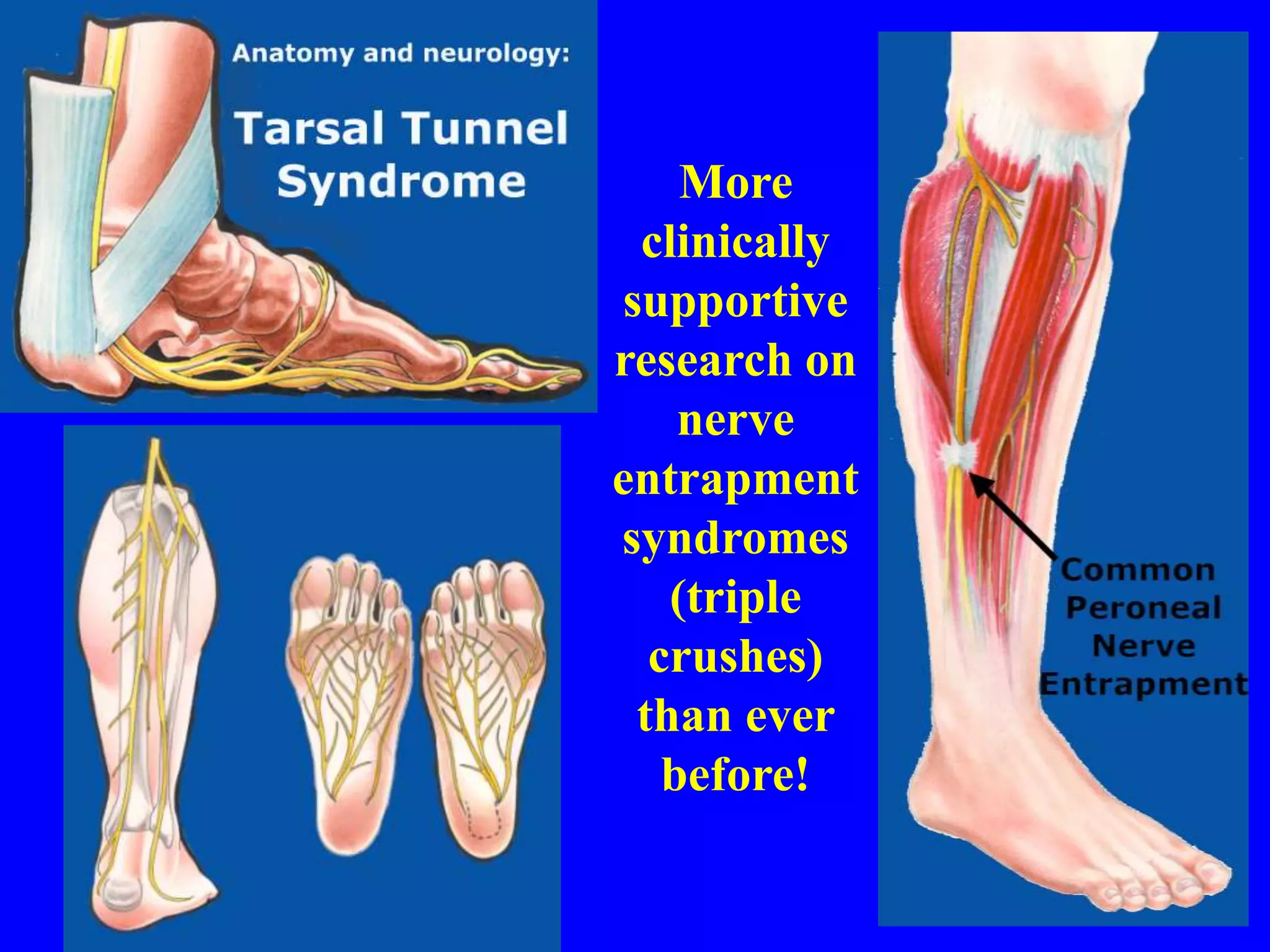 More
clinically
supportive
research on
nerve
entrapment
syndromes
(triple
crushes)
than ever
before!
 