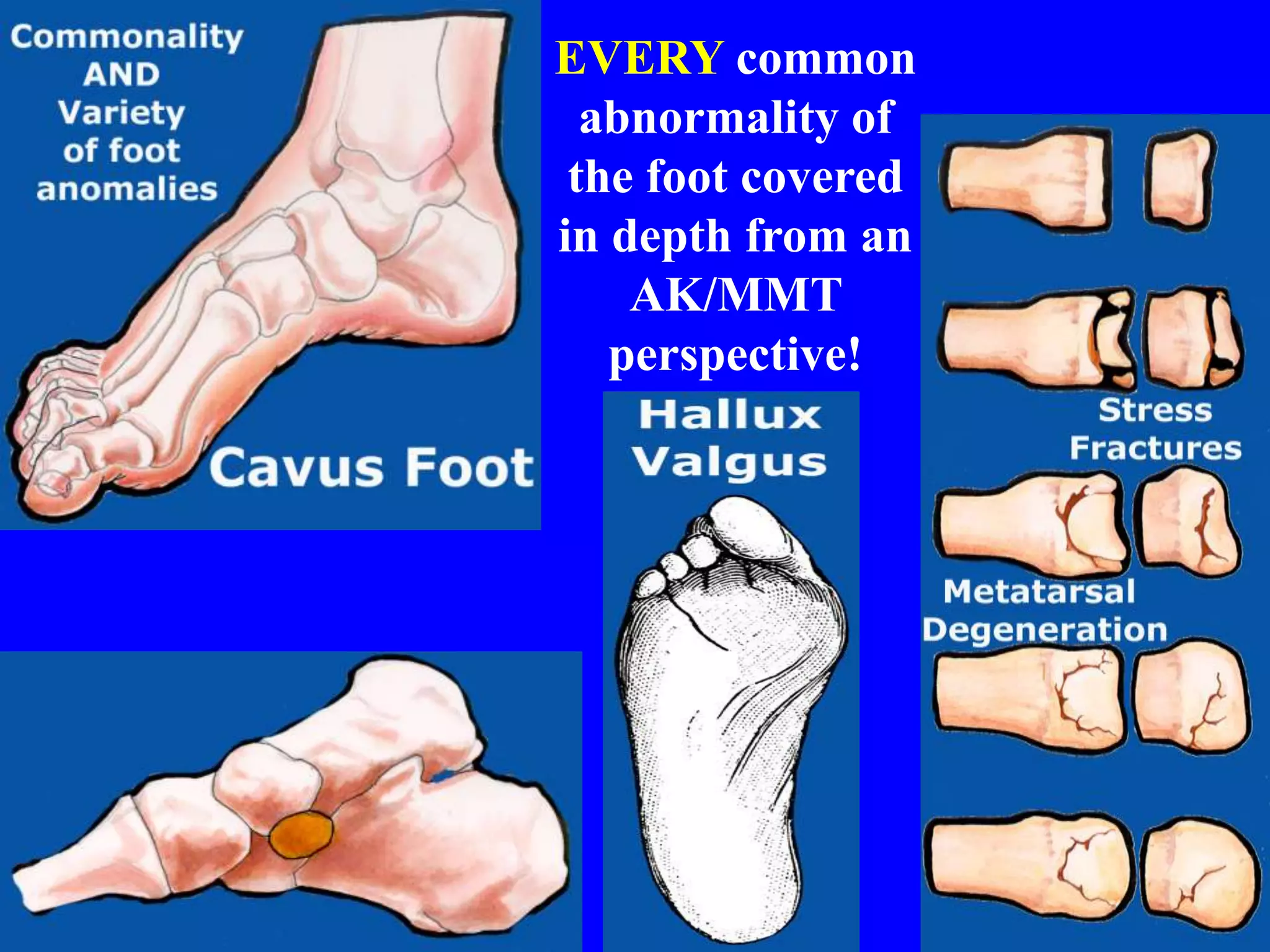 EVERY common
abnormality of
the foot covered
in depth from an
AK/MMT
perspective!
 
