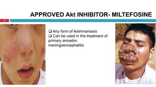 20
APPROVED Akt INHIBITOR- MILTEFOSINE
 Any form of leishmaniasis
 Can be used in the treatment of
primary amoebic
meningoencephalitis
 