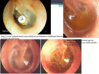 http://www.webmd.boots.com/children/ss/slideshow-childhood-illnesses-
parents-should-know
http://www.childrenent.sg/ear-
problem/glue-ears-or-otitis-media-
with-effusion
25
 