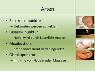 Arten
• Elektroakupunktur
  – Elektroden werden aufgeklemmt
• Laserakupunktur
  – Nadel wird durch Laserlicht ersetzt
• Moxibustion
  – brennendes Kraut wird eingesetzt
• Ohrakupunktur
  – mit Hilfe von Nadeln oder Massage
 