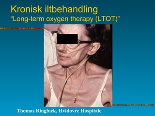 Kronisk iltbehandling
“Long-term oxygen therapy (LTOT)”
Thomas Ringbæk, Hvidovre Hospitale
 