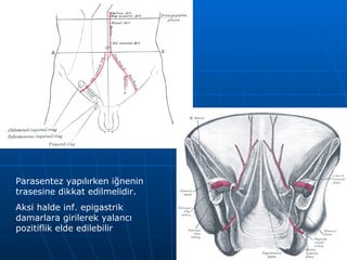 Parasentez yapılırken iğnenin
trasesine dikkat edilmelidir.
Aksi halde inf. epigastrik
damarlara girilerek yalancı
pozitiflik elde edilebilir
 