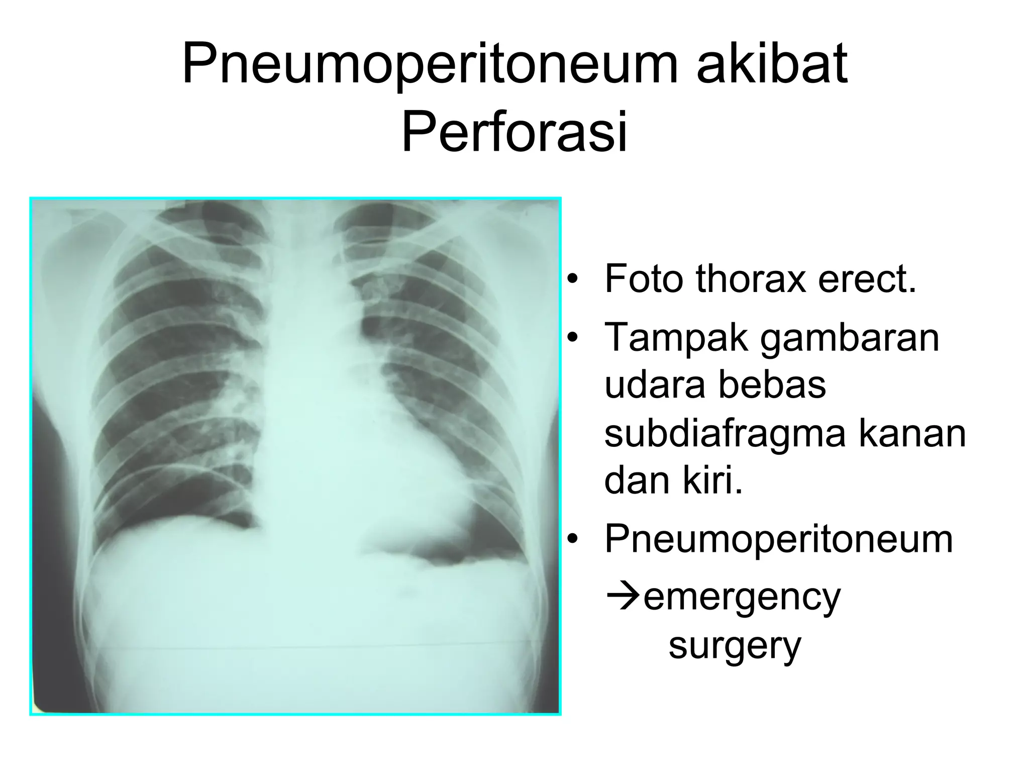 Pneumoperitoneum akibat
Perforasi
• Foto thorax erect.
• Tampak gambaran
udara bebas
subdiafragma kanan
dan kiri.
• Pneumoperitoneum
àemergency
surgery
 