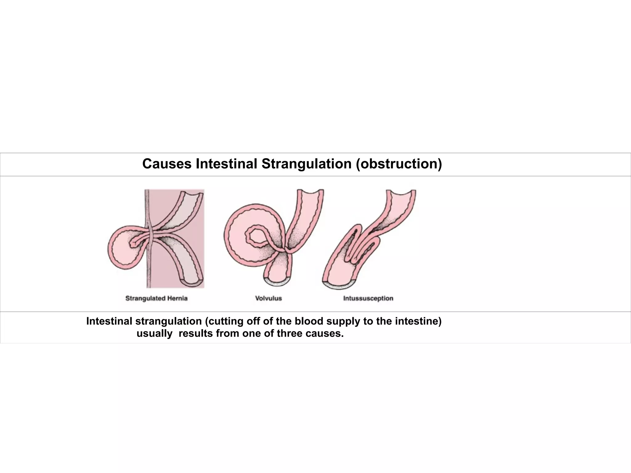 Causes Intestinal Strangulation (obstruction)
Intestinal strangulation (cutting off of the blood supply to the intestine)
usually results from one of three causes.
 