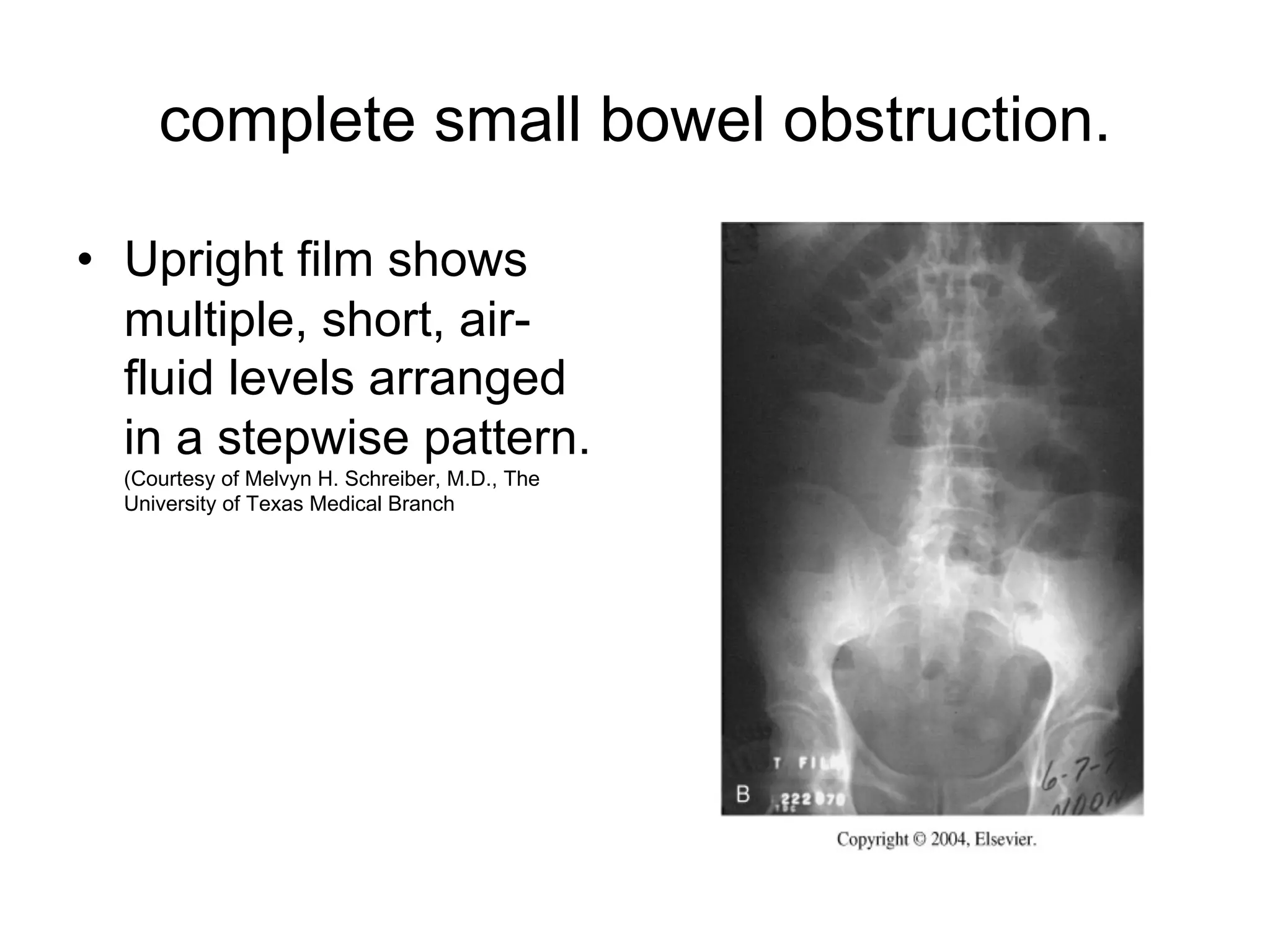 complete small bowel obstruction.
• Upright film shows
multiple, short, air-
fluid levels arranged
in a stepwise pattern.
(Courtesy of Melvyn H. Schreiber, M.D., The
University of Texas Medical Branch
 