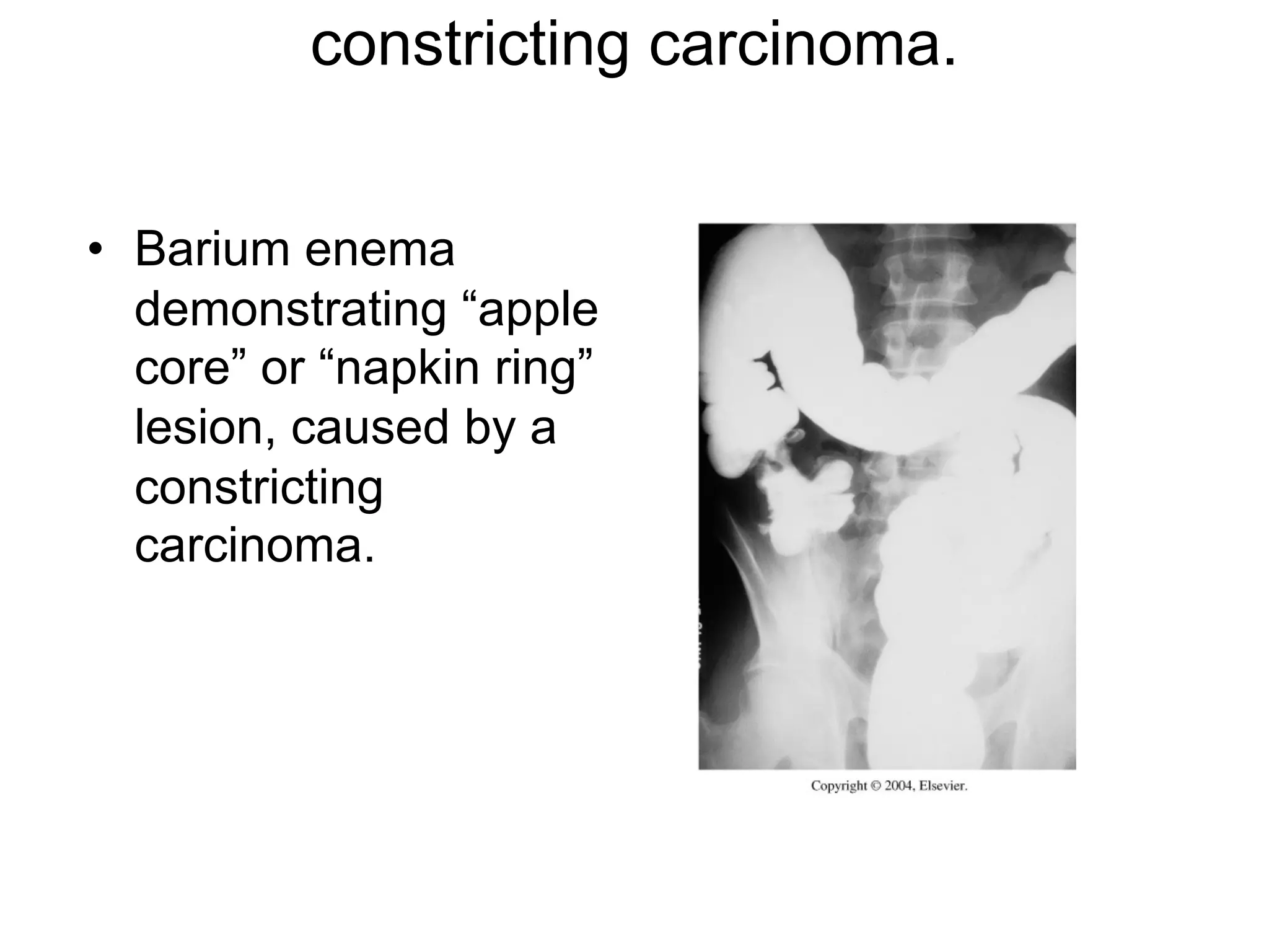 constricting carcinoma.
• Barium enema
demonstrating “apple
core” or “napkin ring”
lesion, caused by a
constricting
carcinoma.
 