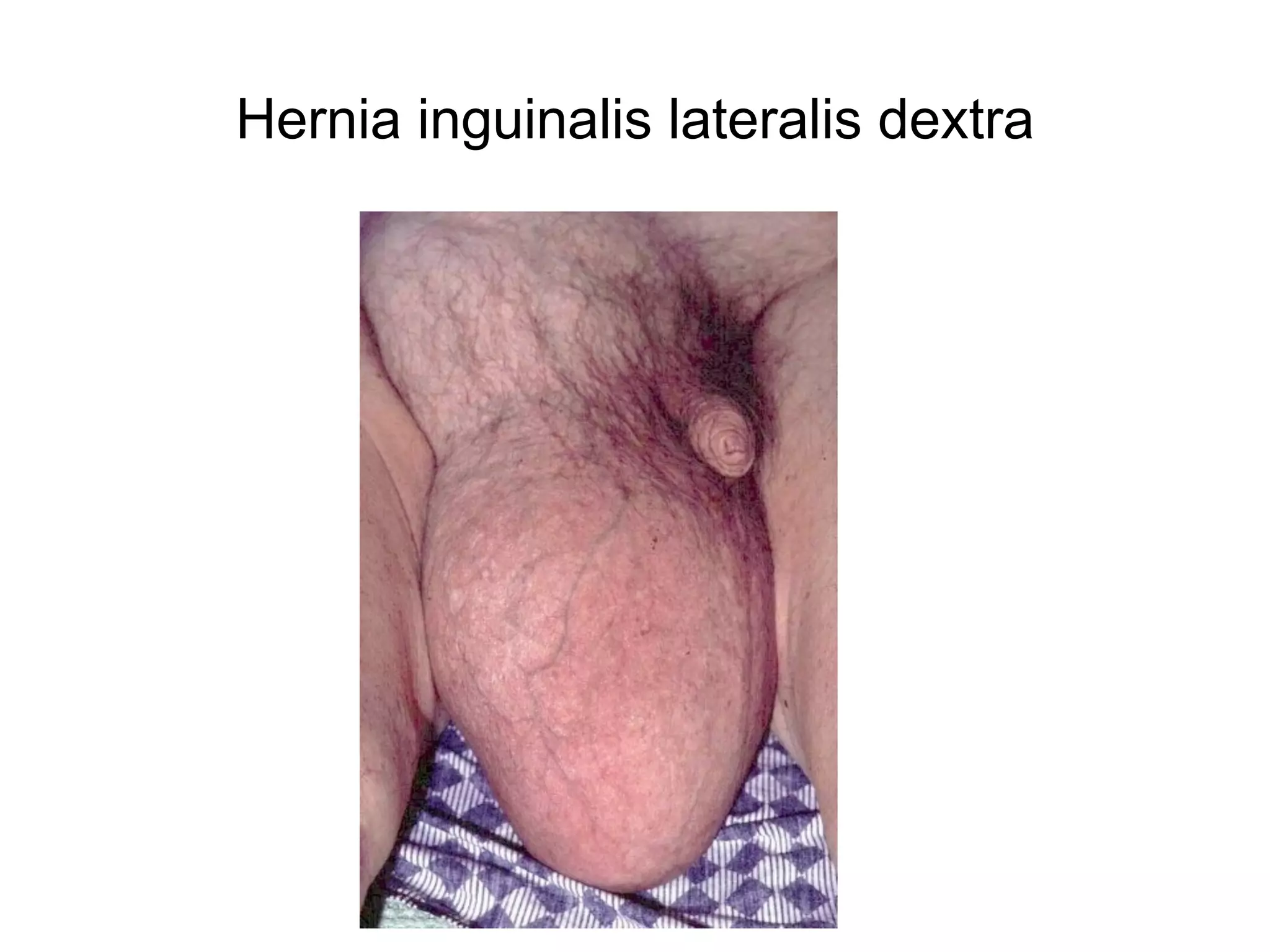 Hernia inguinalis lateralis dextra
 