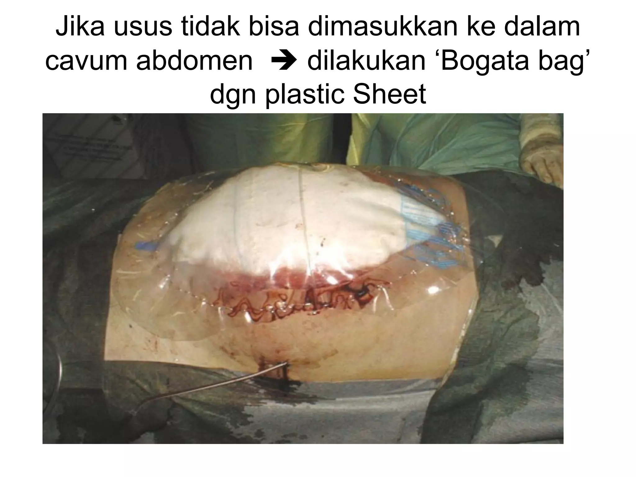 Jika usus tidak bisa dimasukkan ke dalam
cavum abdomen è dilakukan ‘Bogata bag’
dgn plastic Sheet
 