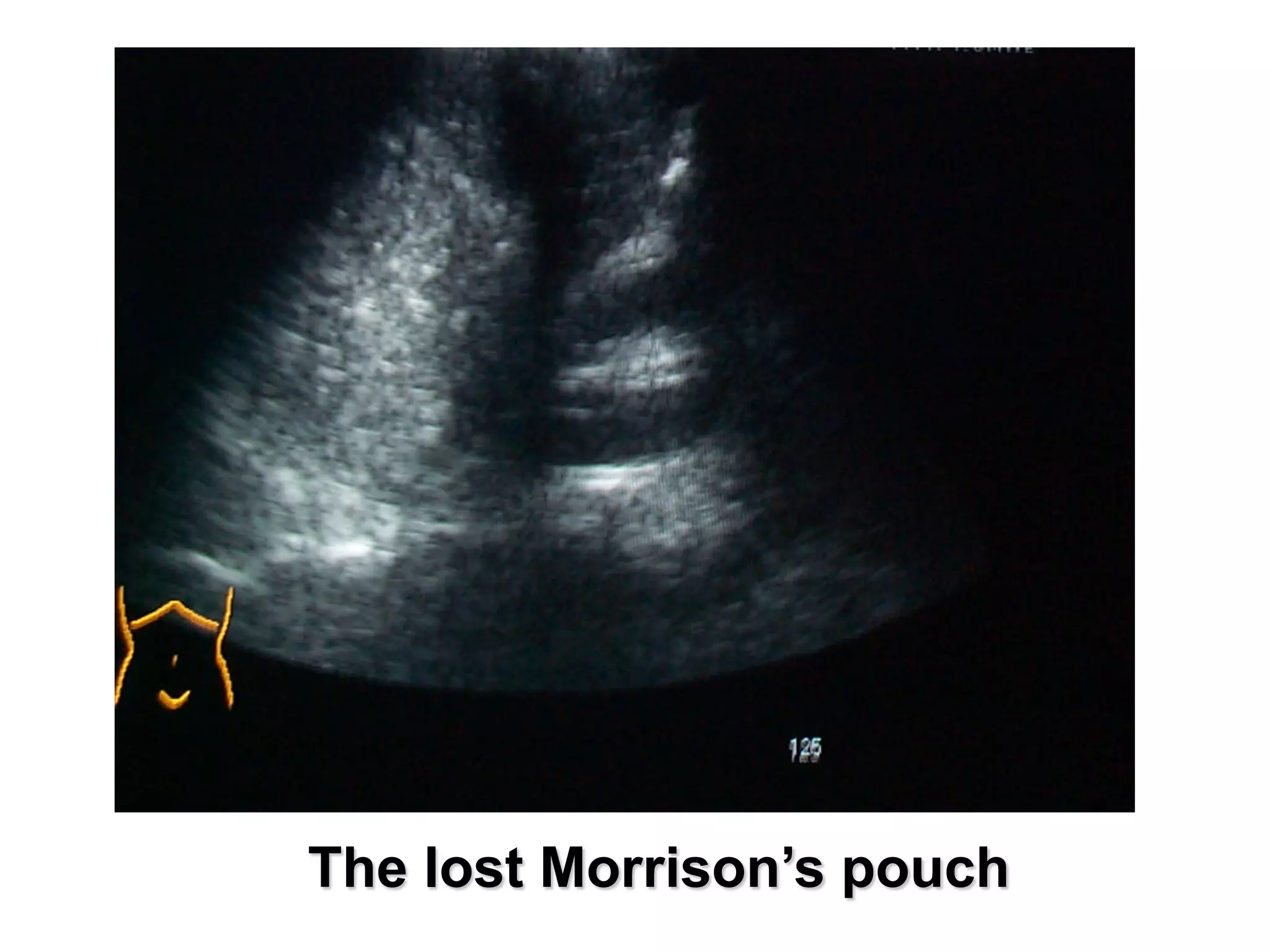 The lost Morrison’s pouch
 