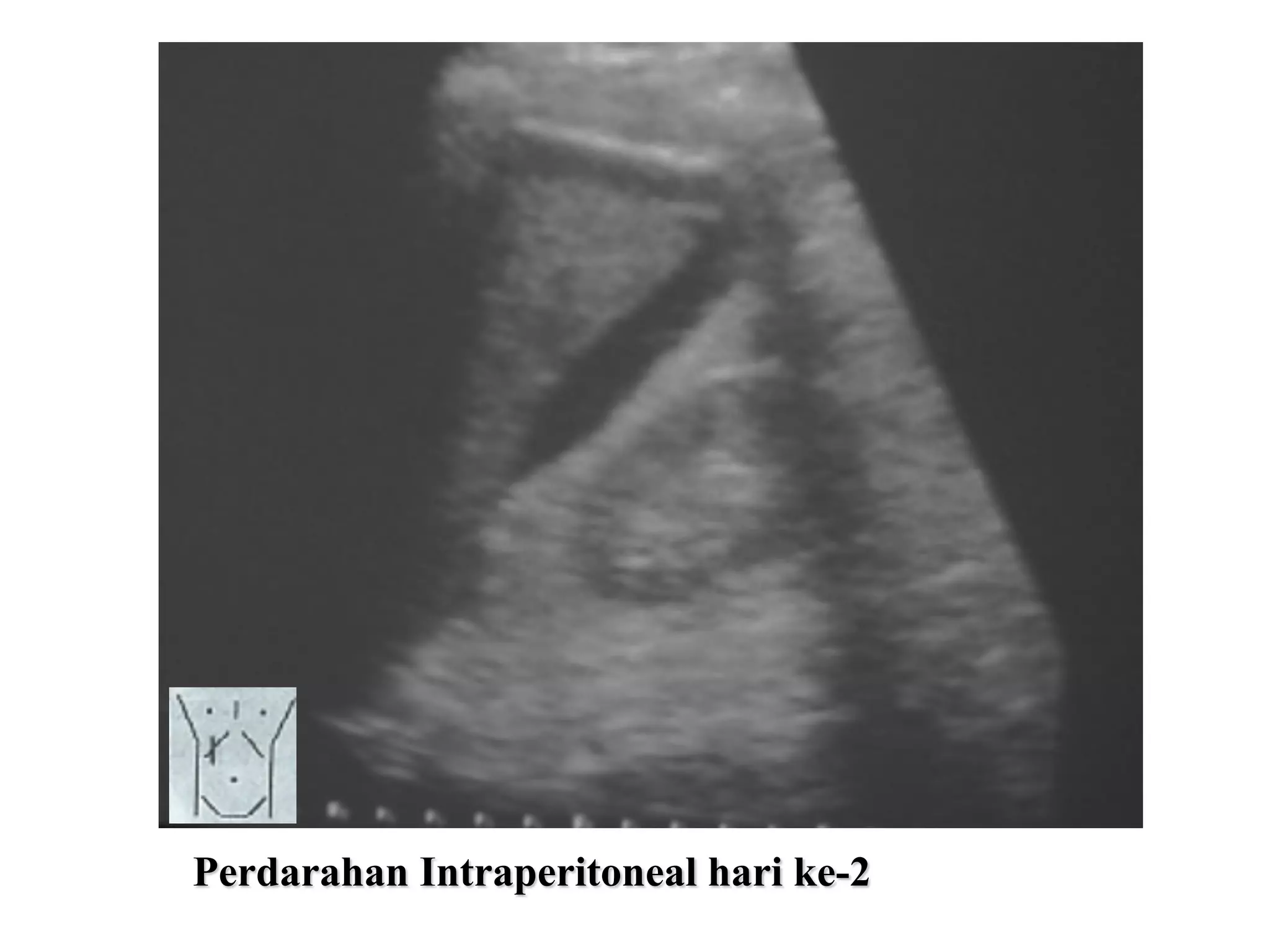 Perdarahan Intraperitoneal hari ke-2
 