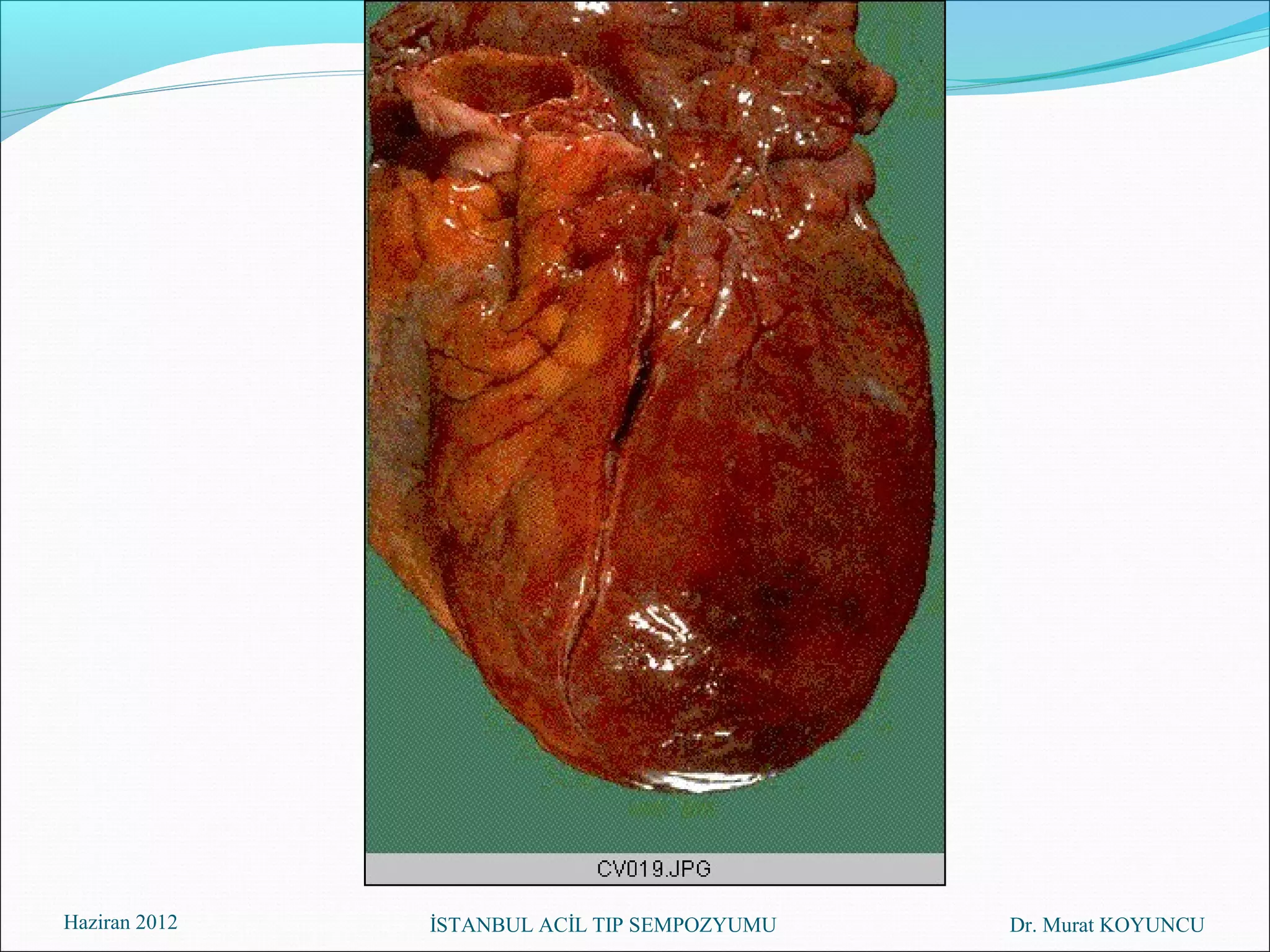 Haziran 2012   İSTANBUL ACİL TIP SEMPOZYUMU   Dr. Murat KOYUNCU
 