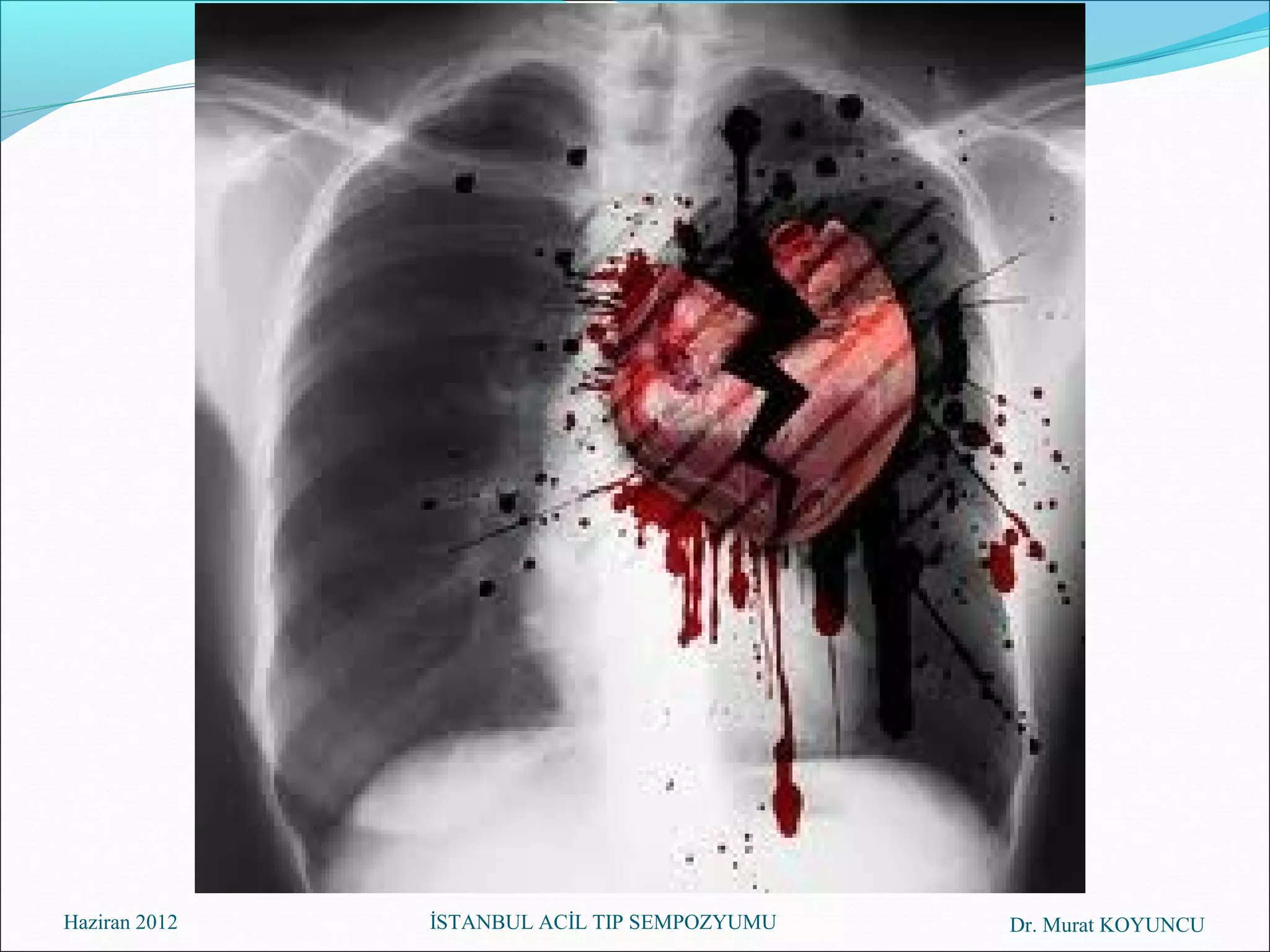 Haziran 2012   İSTANBUL ACİL TIP SEMPOZYUMU   Dr. Murat KOYUNCU
 