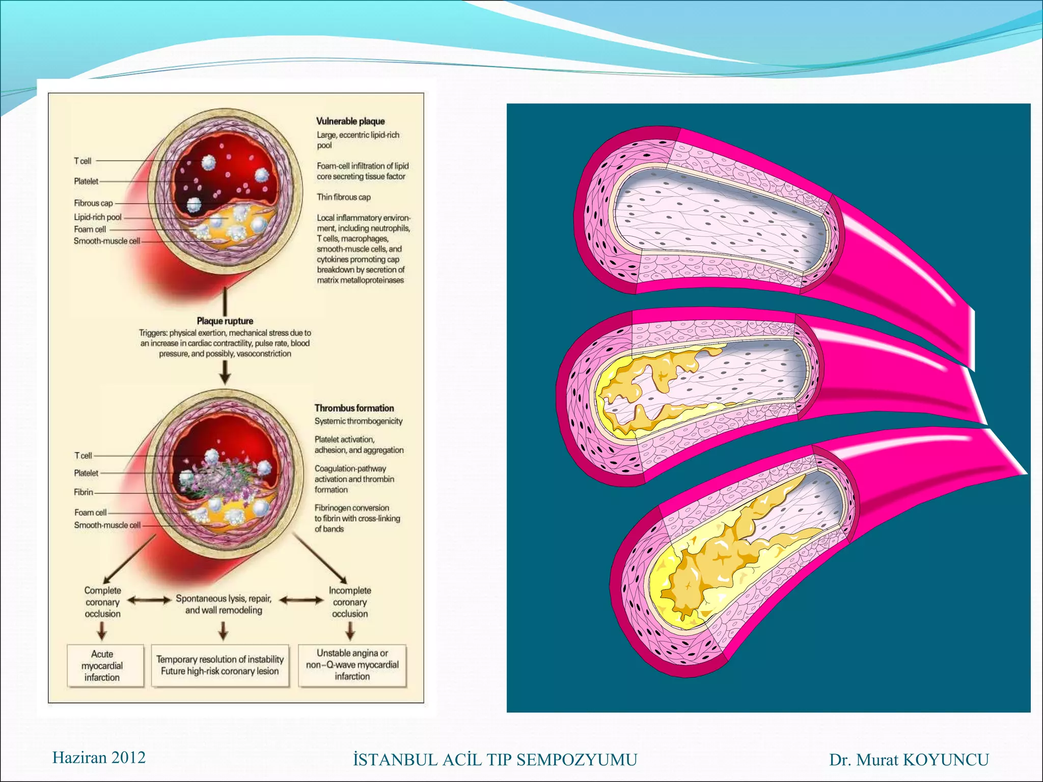 Haziran 2012   İSTANBUL ACİL TIP SEMPOZYUMU   Dr. Murat KOYUNCU
 