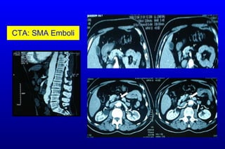 CTA: SMA Emboli 