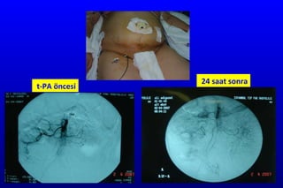 t-PA öncesi 24 saat sonra 