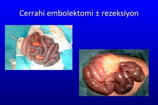 Cerrahi embolektomi ± rezeksiyon 