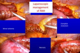 Laparoscopic  management  of  A MI Minor ischemia Necrosis Complete  resolution 