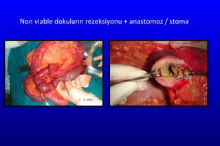 Non viable dokuların rezeksiyonu + anastomoz / stoma 