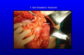 7. Gün Duodeno- ileostomi Transvers kolon Duodenum  İleum 