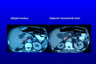 Çölyak trunkus Süperior mezenterik arter 