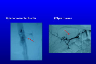 Süperior mezenterik arter Çölyak trunkus 