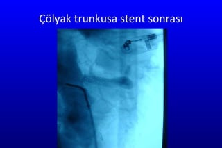 Çölyak trunkusa stent sonrası 