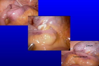 Çekum Terminal ileum 