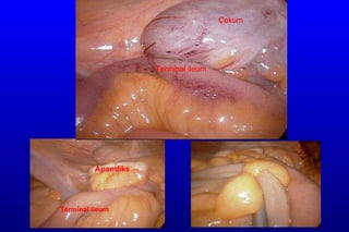 Üçüncül Bakı Terminal ileum Apandiks Çekum Terminal ileum 