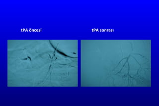tPA öncesi tPA sonrası 