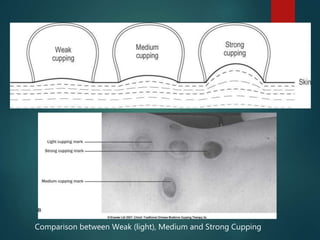 Comparison between Weak (light), Medium and Strong Cupping
 