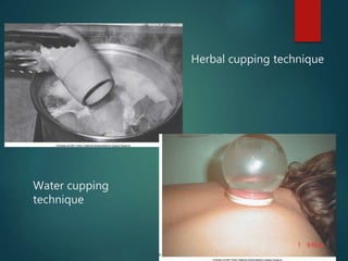 Herbal cupping technique
Water cupping
technique
 